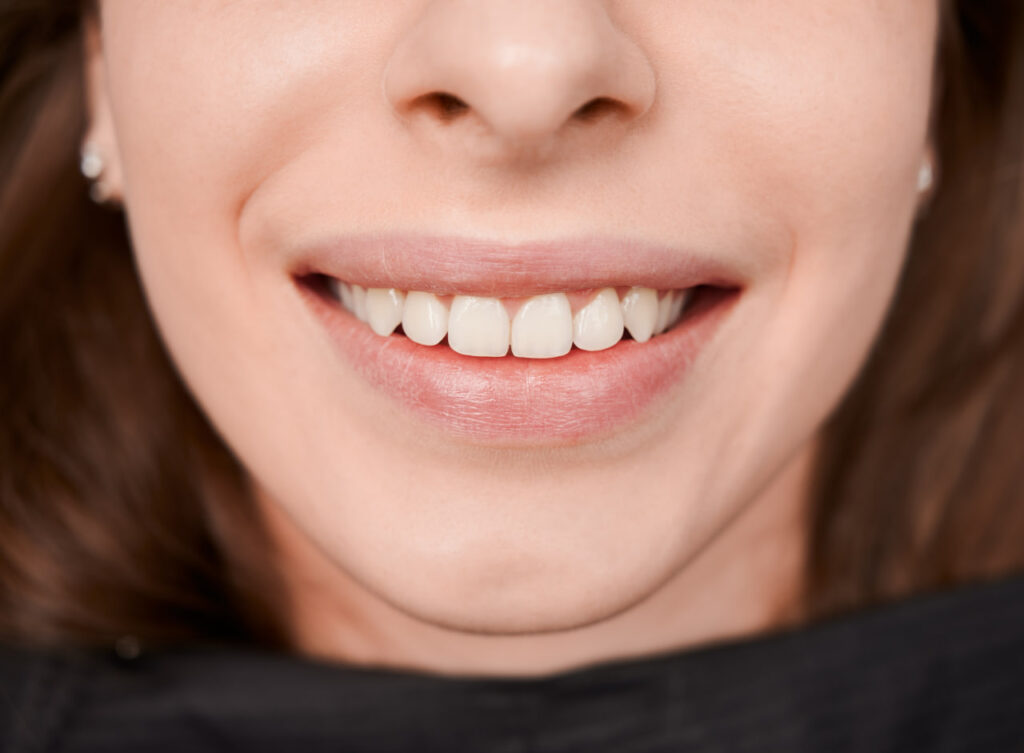 Close-up of a patient’s Hollywood Smile in Turkey showing balanced tooth proportions and healthy gums