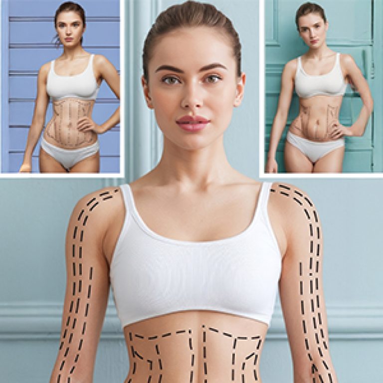 Body Contouring surgery lines